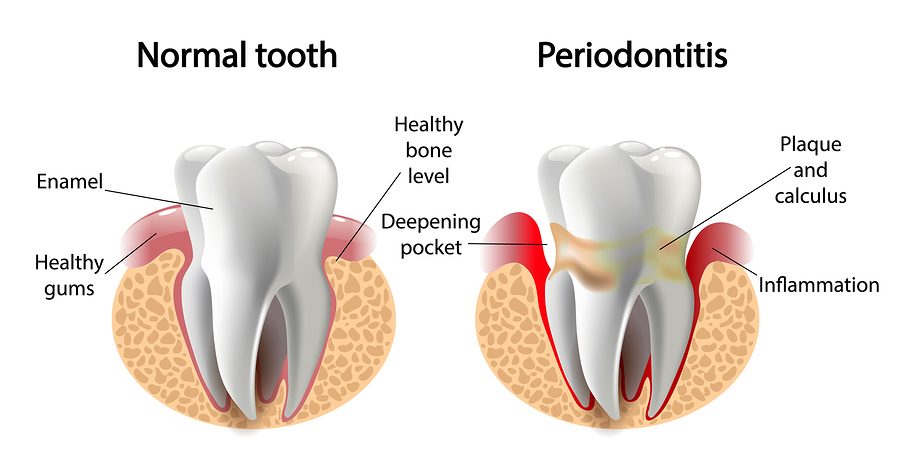 The Connection Between Gum Disease and Dementia