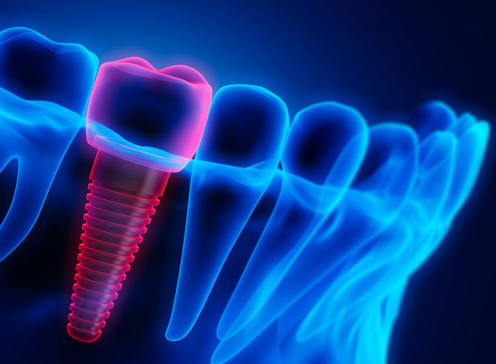 How Can Dental Implants Restore Your Natural Smile
