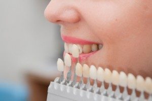 Unveiling the Smile Transformation: The Magic of Dental Veneers