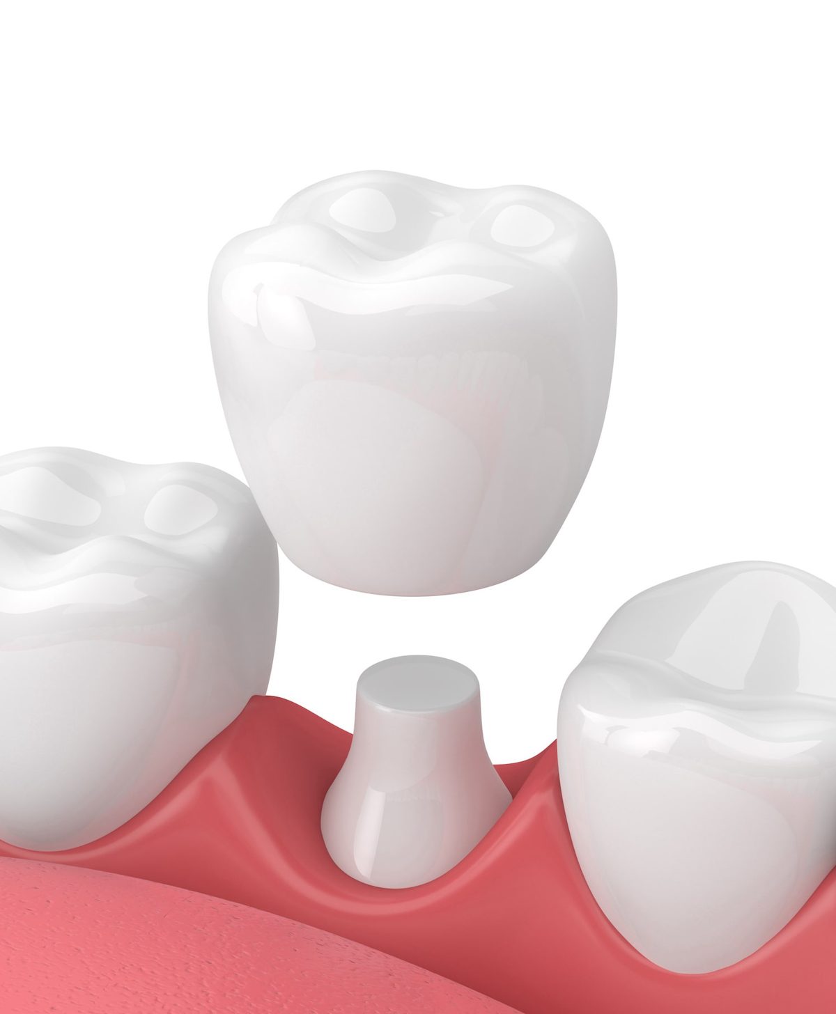 What You Need to Know About a Dental Crown